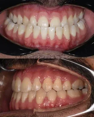 ✨ Private Fixed Braces Transformation ✨A beautiful smile transformation with private fixed braces 🦷✨Our patient wanted to improve the alignment of their teeth and achieve a more confident, natural looking smile - and what a result! 😍✔️ Improved tooth alignment
✔️ More balanced smile
✔️ Tailored treatment plan
✔️ A smile to feel confident about 💫Every smile is unique, and your treatment plan should be too. 🤍01455 637142 - 0121 476 6218 📞
houseofdental.co.uk 📧