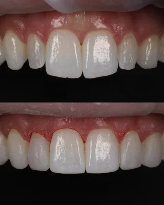 The power of composite bonding ✨🦷A beautiful smile refresh using composite bonding, carefully shaped to create a more harmonious and natural looking result.From the shape and proportions to the finer details, every part of the smile has been tailored to this patient.Natural. Subtle. Transformative. 🤍01455 637142 - 0121 476 6218 📞
houseofdental.co.uk 📧