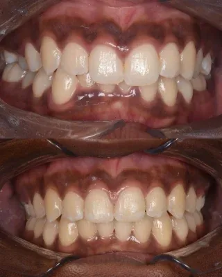 The lower teeth deserve their own spotlight! 🦷✨A closer look at the lower arch following this patient’s fixed braces treatment.The detail, alignment and overall transformation really come together when you see the lower teeth up close. 🙌🏼One smile, two arches, one incredible transformation. ✨01455 637142 - 0121 476 6218 📞
houseofdental.co.uk 📧