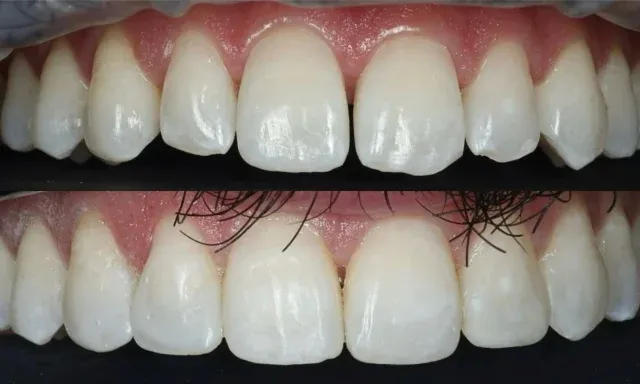 A subtle yet beautiful smile enhancement using teeth whitening, followed by composite bonding on the upper front teeth 🦷🤍Our aim was to create a more harmonious smile while keeping the result natural, balanced and tailored to the patient.✔️ Enhanced tooth shape
✔️ Improved symmetry
✔️ Natural looking finish
✔️ Minimally invasive smile enhancementSometimes small changes can make a big difference to your smile confidence. 😍Interested in composite bonding? Get in touch with our team to discuss how we can enhance your smile.01455 637142 - 0121 476 6218 📞
houseofdental.co.uk 📧