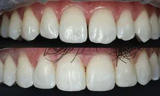 A subtle yet beautiful smile enhancement using teeth whitening, followed by composite bonding on the upper front teeth 🦷🤍Our aim was to create a more harmonious smile while keeping the result natural, balanced and tailored to the patient.✔️ Enhanced tooth shape
✔️ Improved symmetry
✔️ Natural looking finish
✔️ Minimally invasive smile enhancementSometimes small changes can make a big difference to your smile confidence. 😍Interested in composite bonding? Get in touch with our team to discuss how we can enhance your smile.01455 637142 - 0121 476 6218 📞
houseofdental.co.uk 📧