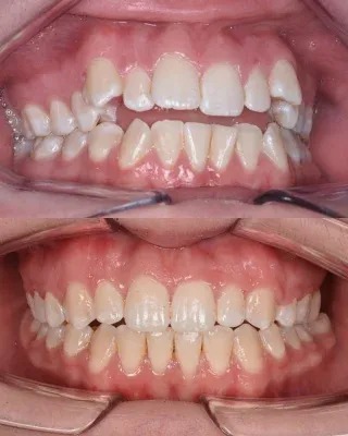 A beautiful smile transformation! 🦷✨This patient has completed their fixed braces treatment, achieving a straighter, more confident smile. 🤍Braces off - transformation complete! ✨01455 637142 - 0121 476 6218 📞
houseofdental.co.uk 📧