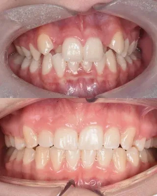 Braces off and a brand new smile unlocked! ✨🦷What a transformation for this patient following their fixed braces treatment! 😍Carefully aligning the teeth has created a beautifully balanced smile - and we absolutely love the final result.The best part? Seeing the confidence that comes with it. 🤍01455 637142 - 0121 476 6218 📞
houseofdental.co.uk 📧